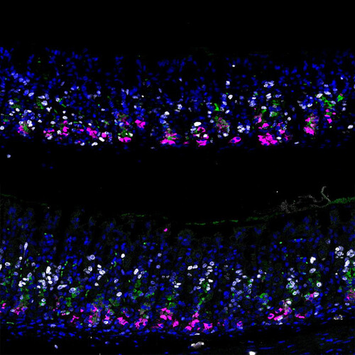 Normal mouse stomach epithelium (above) versus epithelium with p57 overexpression (below) at day 3 post-injury with high-dose tamoxifen (HDT). The epithelium is stained for chief cells (magenta), neck cells (green), and proliferating cells (white). ©Lee/Koo/CellStemCell/IMBA.